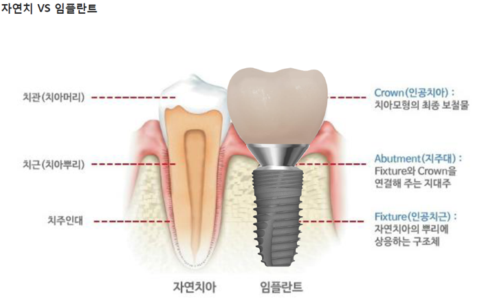 자연치와 임플란트 비교. 임플란트는 인공치관 Crown, 지대주 Abutment, 인공치근 Fixture로 구성됩니다.